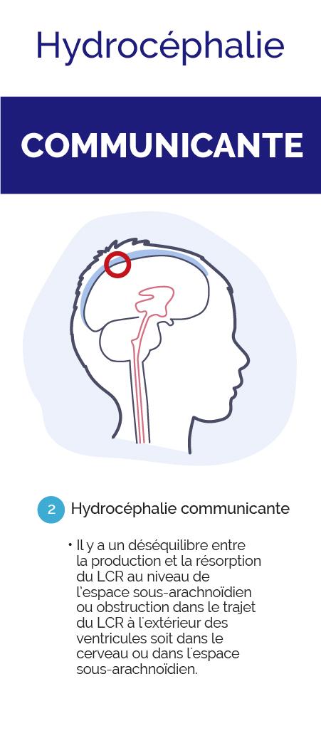 Infographie sur l'hydrocéphalie communicante