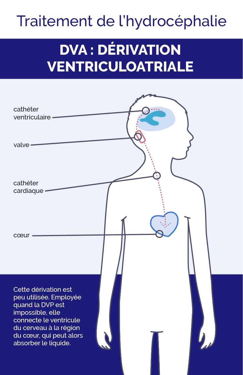 Infographique de la dérivation ventriculoatriale
