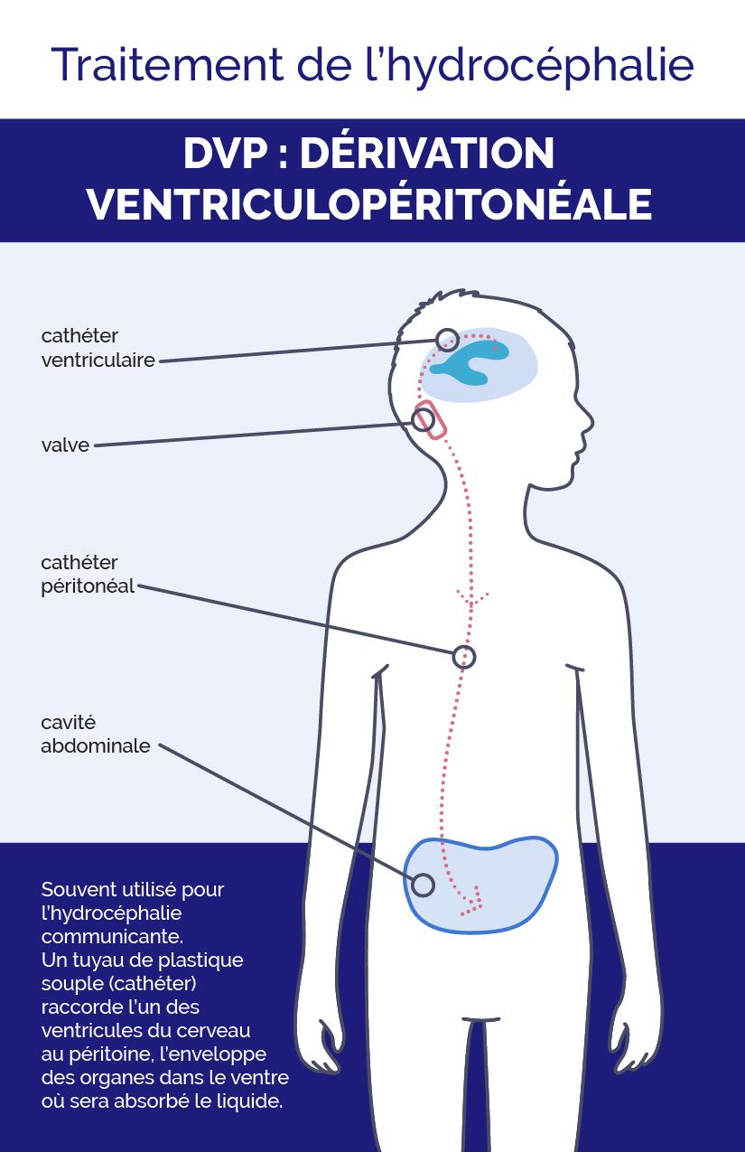Infographie de la dérivation ventriculopéritonéale
