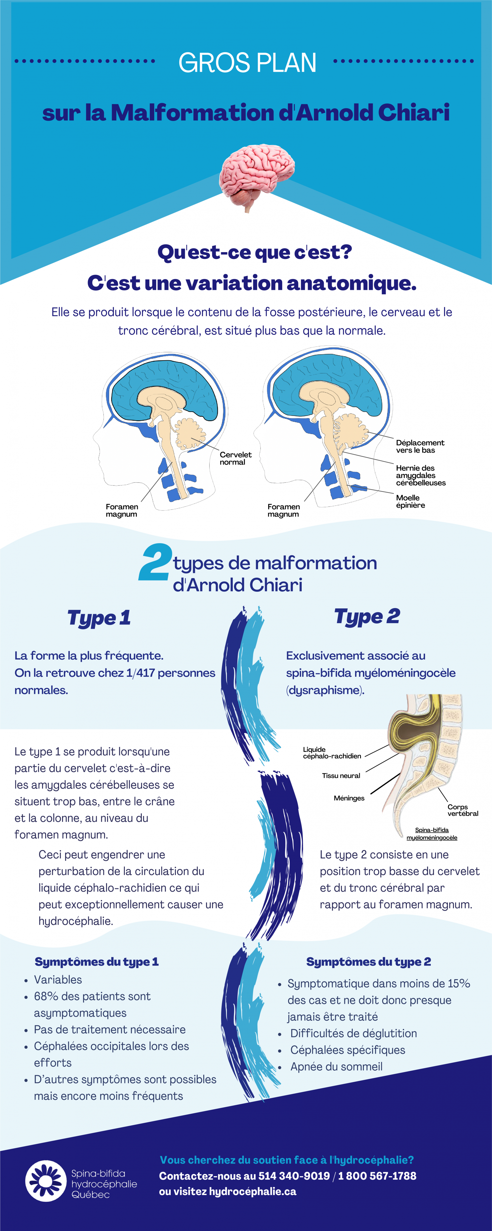 Explication de la malformation de Chiari et de ses deux types