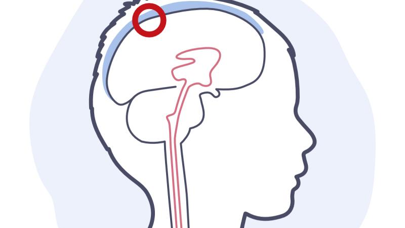 Illustration d'une hydrocéphalie communicante