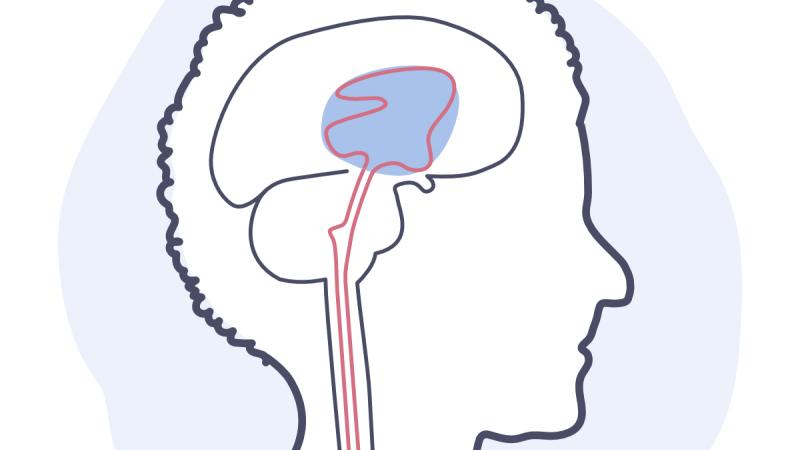 Illustration d'une hydrocéphalie à pression normale