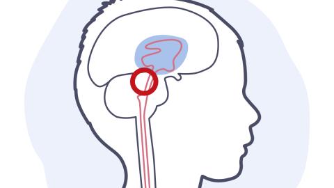 Illustration d'une hydrocéphalie obstructive