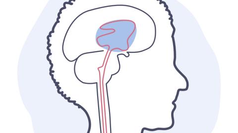 Illustration d'une hydrocéphalie à pression normale